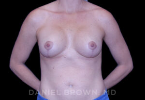 Breast Lift & Implant - Case 1817 - After