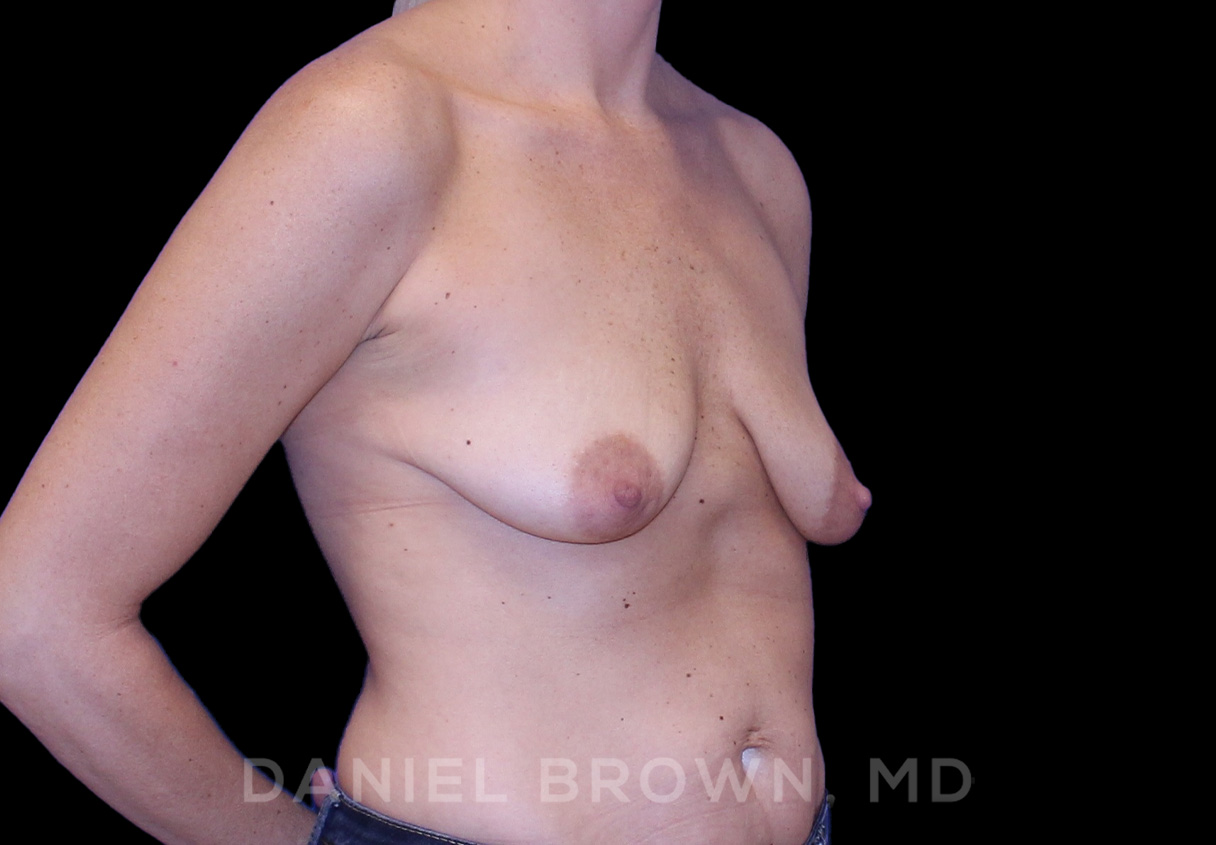 Breast Lift & Implant Patient Photo - Case 1817 - before view-