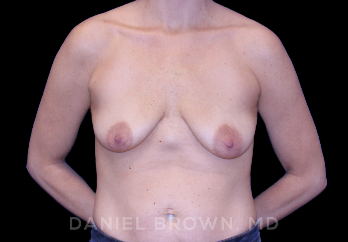 Breast Lift & Implant Patient Photo - Case 1817 - before view-0