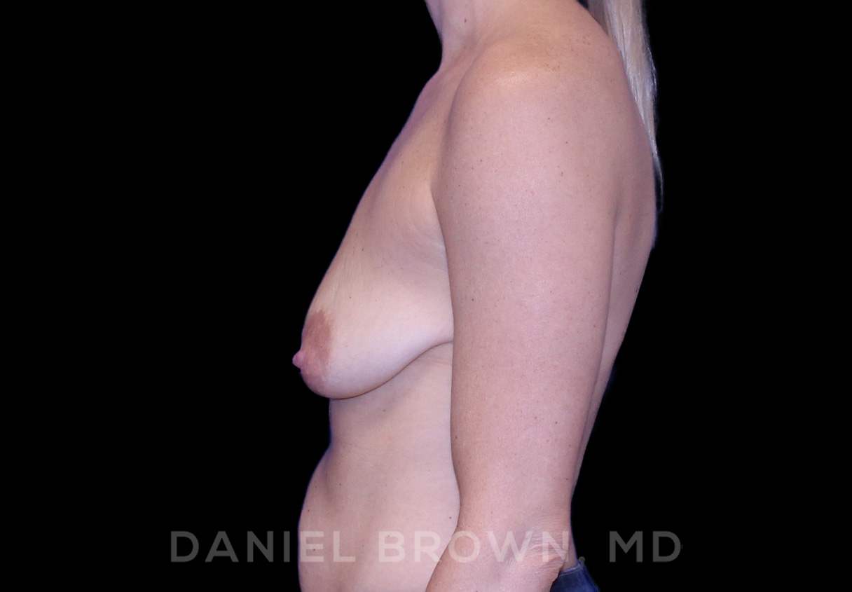 Breast Lift & Implant Patient Photo - Case 1817 - before view-3