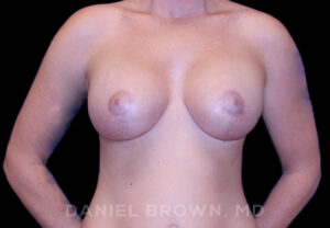 Breast Lift & Implant - Case 1828 - After