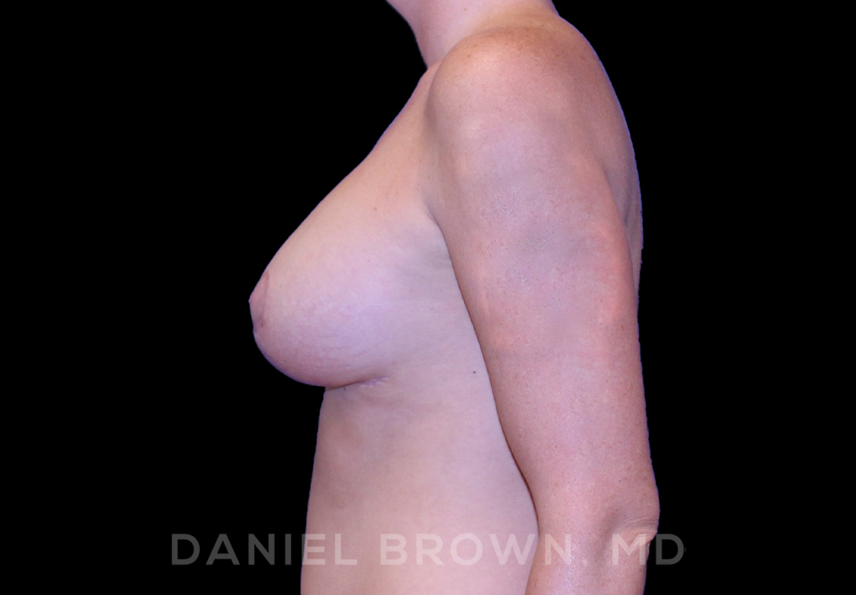 Breast Lift & Implant Patient Photo - Case 1828 - after view