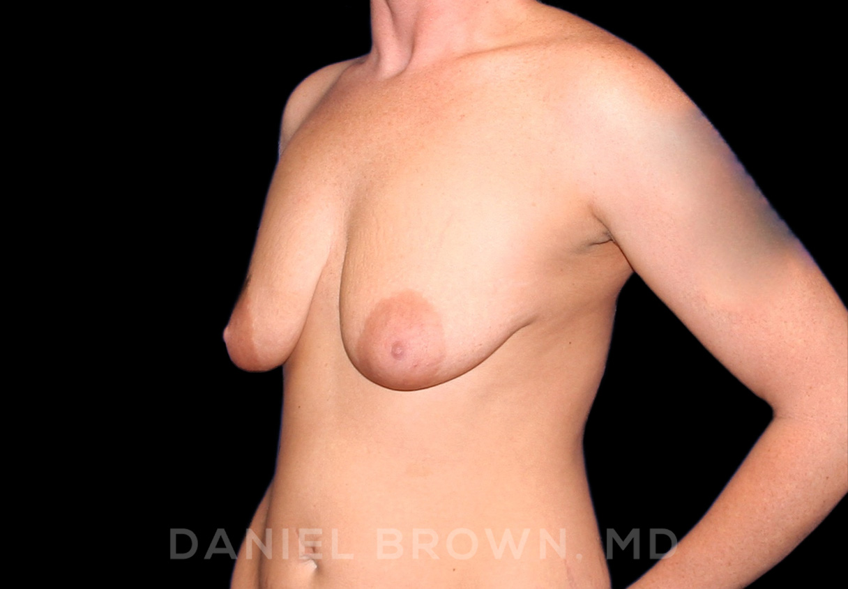 Breast Lift & Implant Patient Photo - Case 1828 - before view-
