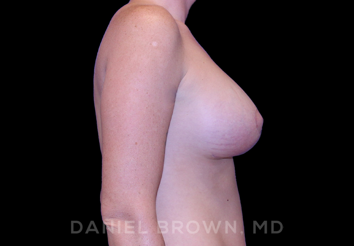 Breast Lift & Implant Patient Photo - Case 1828 - after view