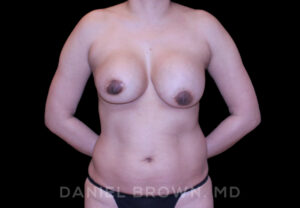 Breast Lift & Implant - Case 1839 - Before