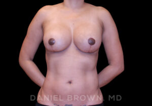 Breast Lift & Implant - Case 1839 - After