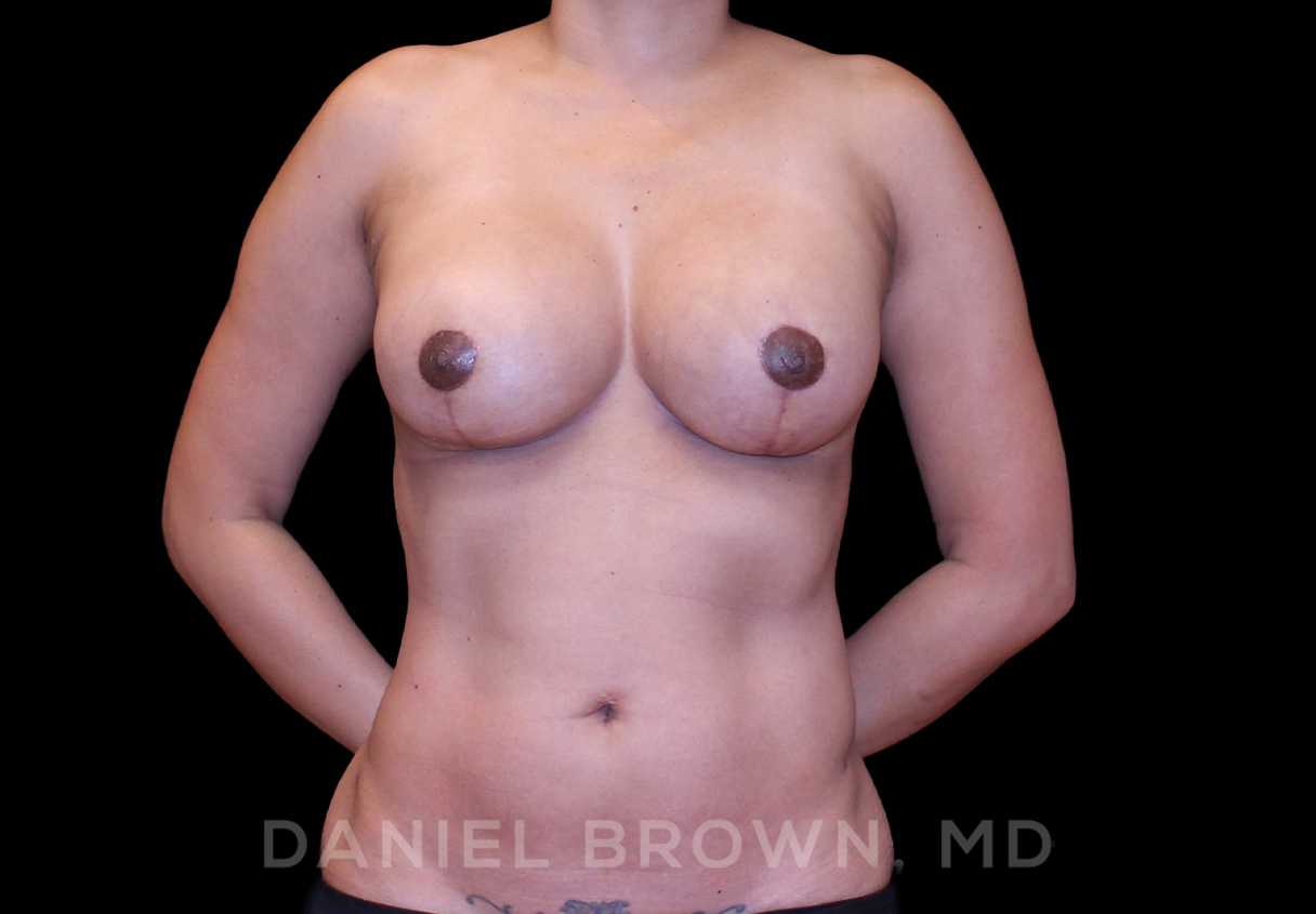 Breast Lift & Implant Patient Photo - Case 1839 - after view-0