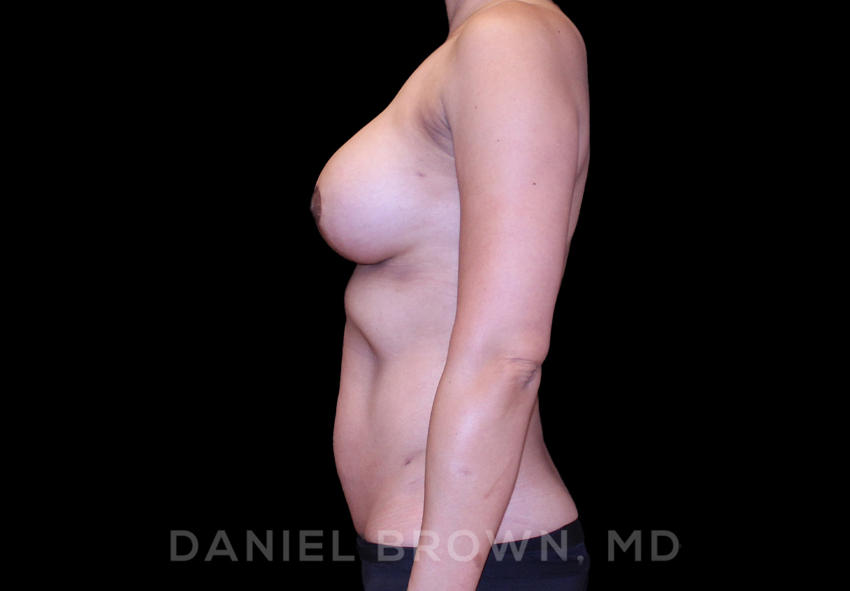Breast Lift & Implant Patient Photo - Case 1839 - after view-3