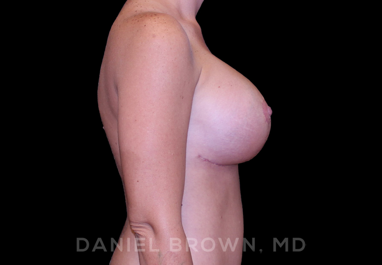 Breast Lift & Implant Patient Photo - Case 1850 - after view-5