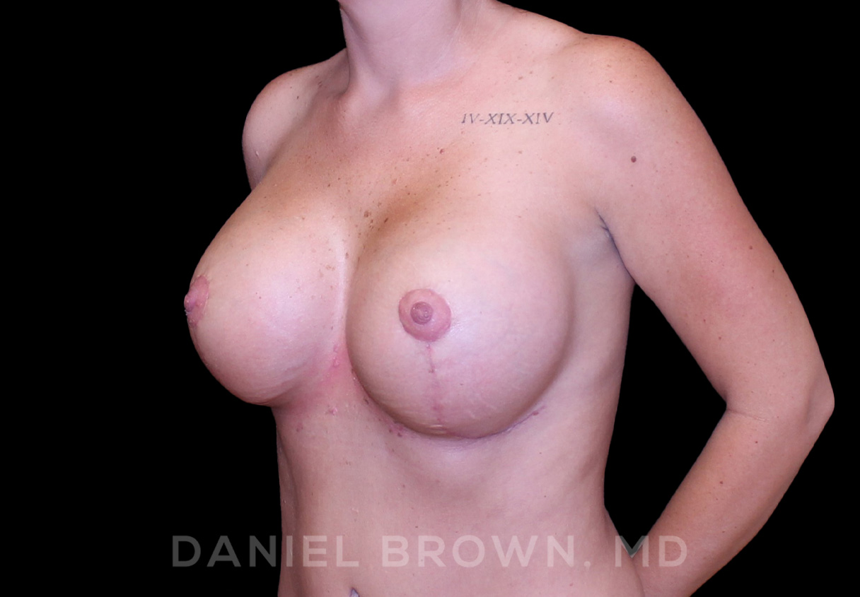 Breast Lift & Implant Patient Photo - Case 1850 - after view