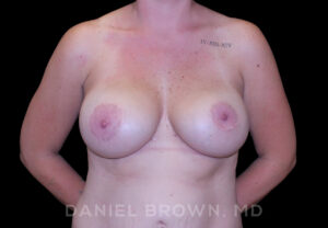 Breast Lift & Implant - Case 1850 - Before
