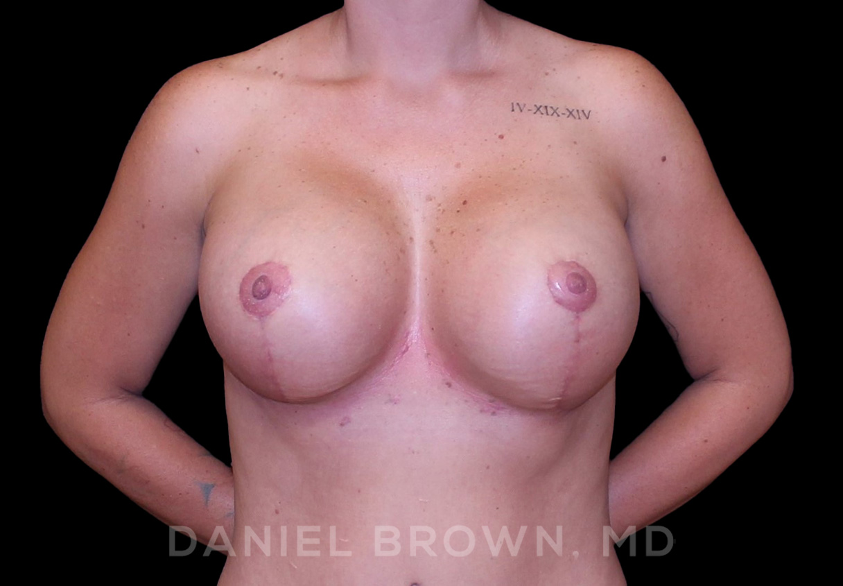 Breast Lift & Implant Patient Photo - Case 1850 - after view-0