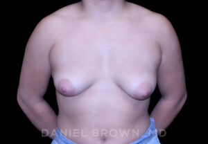 Breast Lift & Implant - Case 1861 - Before