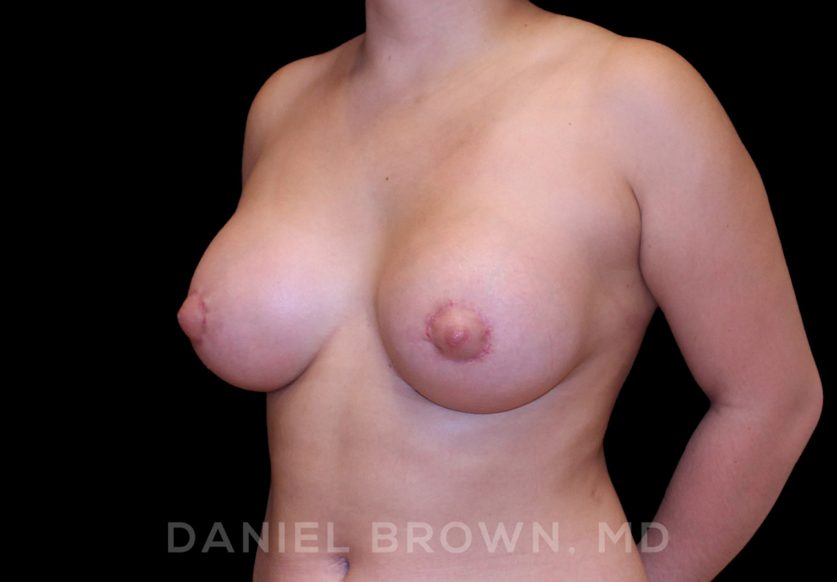 Breast Lift & Implant Patient Photo - Case 1861 - after view