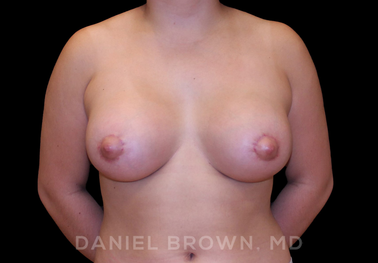 Breast Lift & Implant Patient Photo - Case 1861 - after view-0