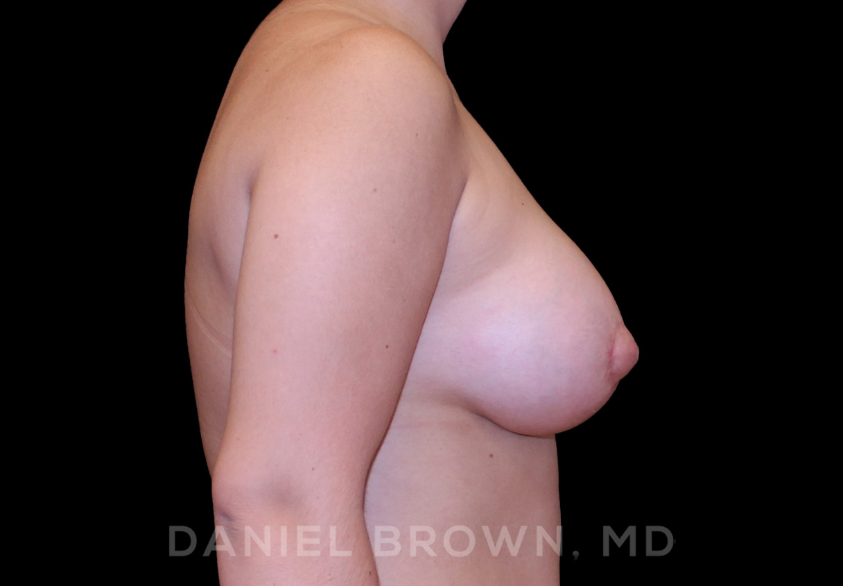 Breast Lift & Implant Patient Photo - Case 1861 - after view-4