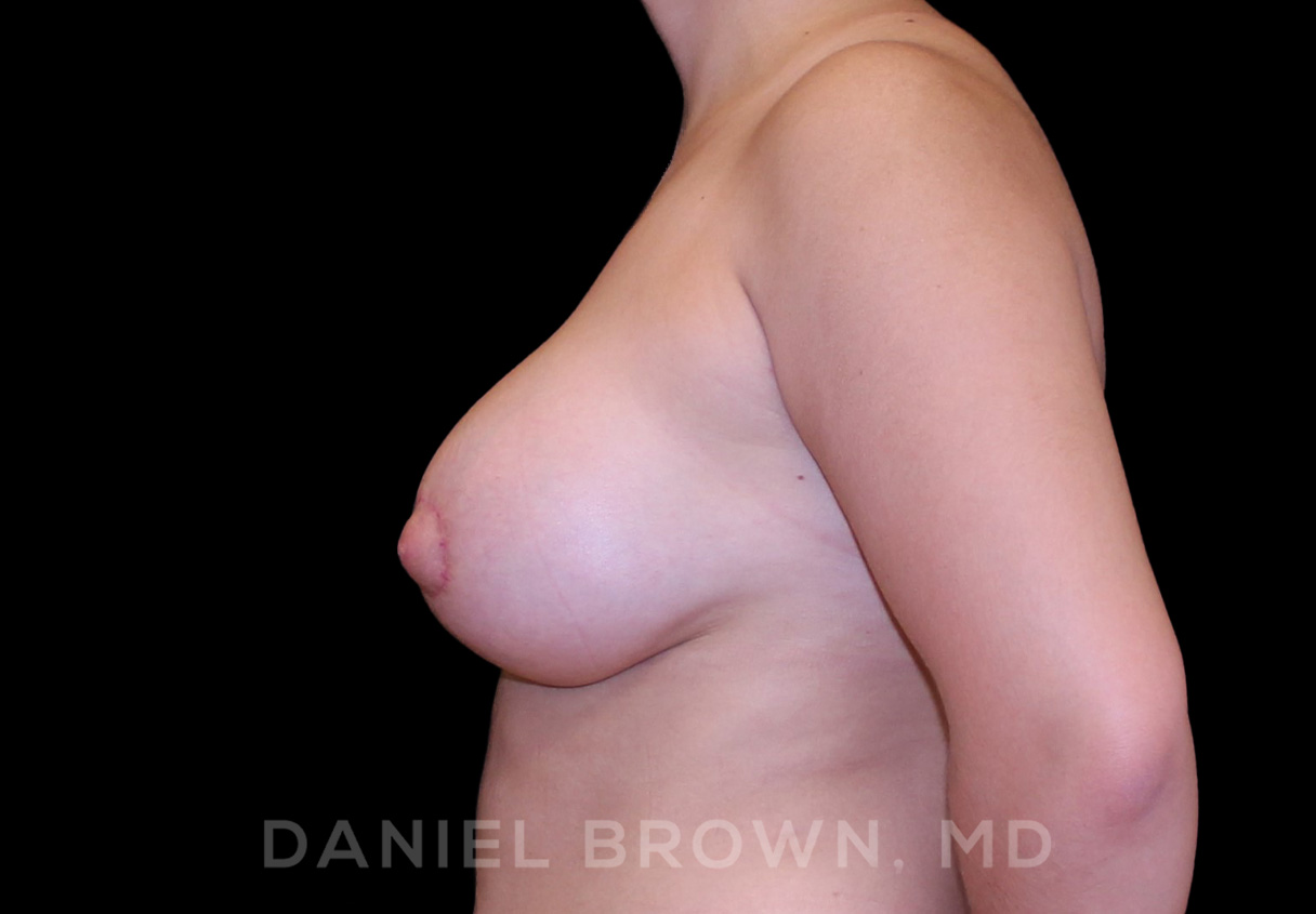 Breast Lift & Implant Patient Photo - Case 1861 - after view-3