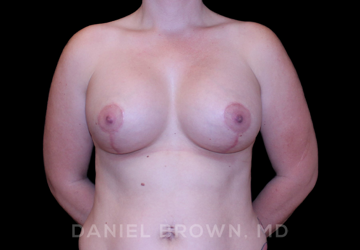Breast Lift & Implant Patient Photo - Case 1872 - after view-0
