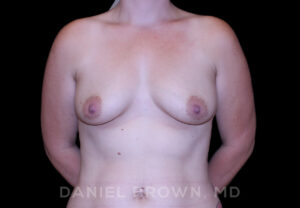 Breast Lift & Implant - Case 1872 - Before