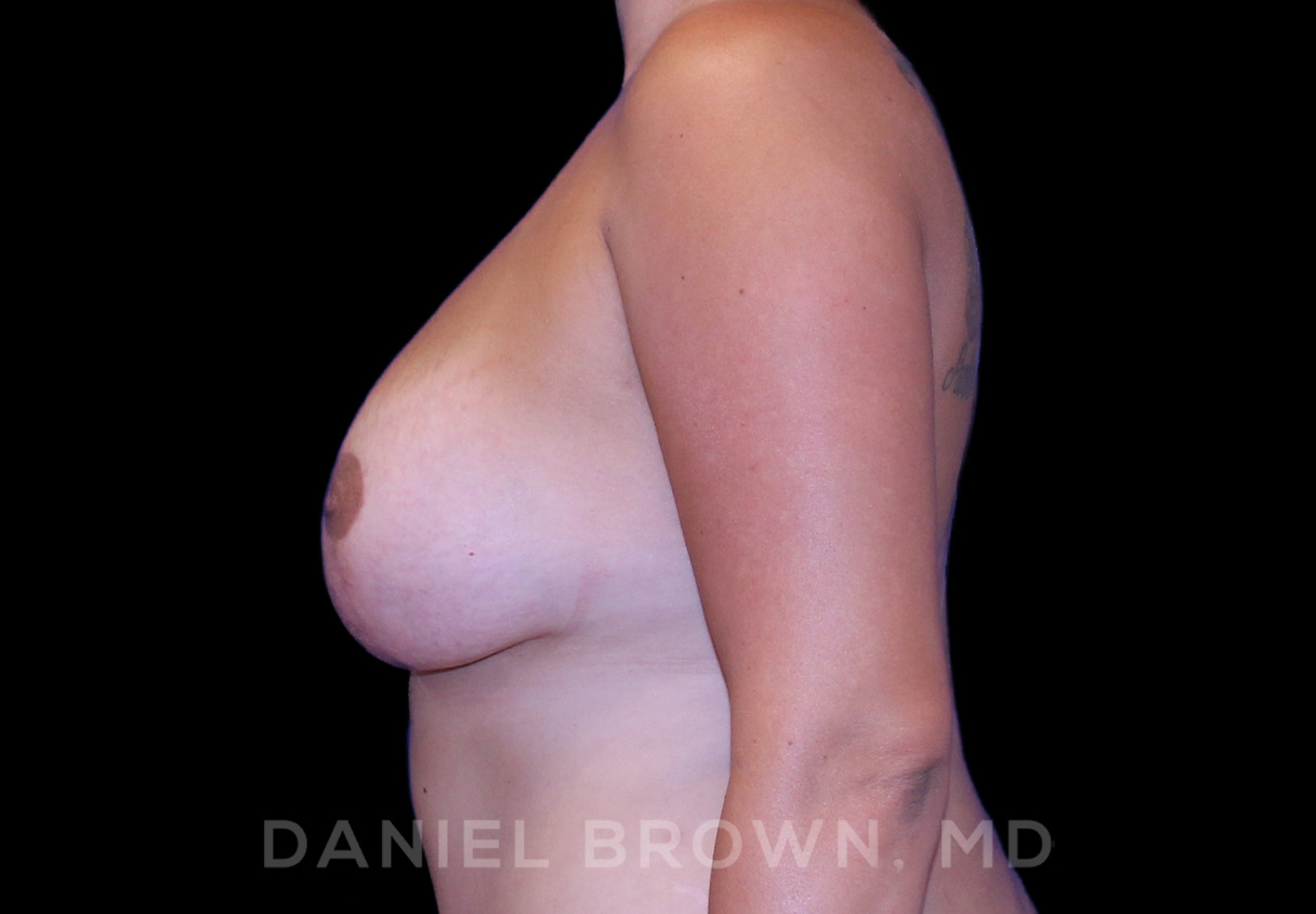 Breast Lift & Implant Patient Photo - Case 1883 - after view-3