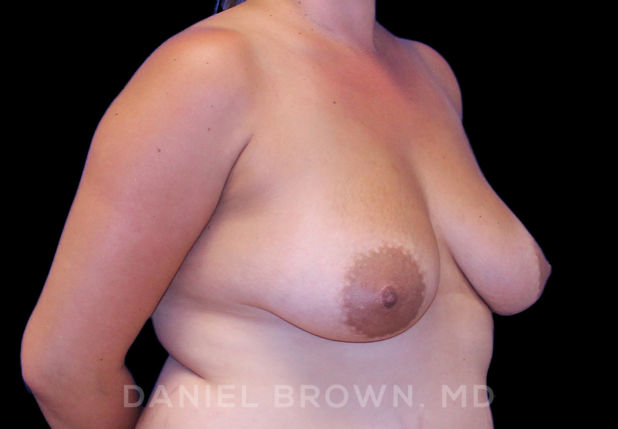 Breast Lift & Implant Patient Photo - Case 1883 - before view-2