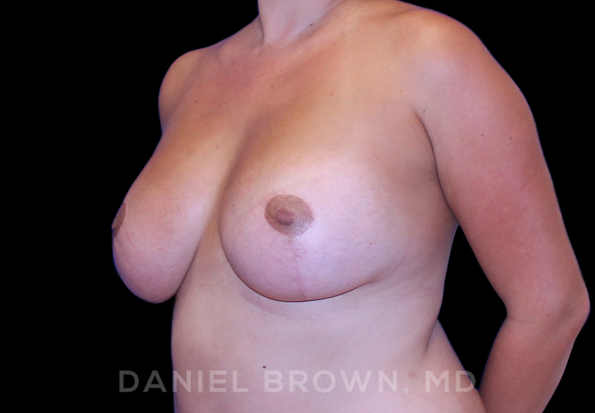Breast Lift & Implant Patient Photo - Case 1883 - after view-1