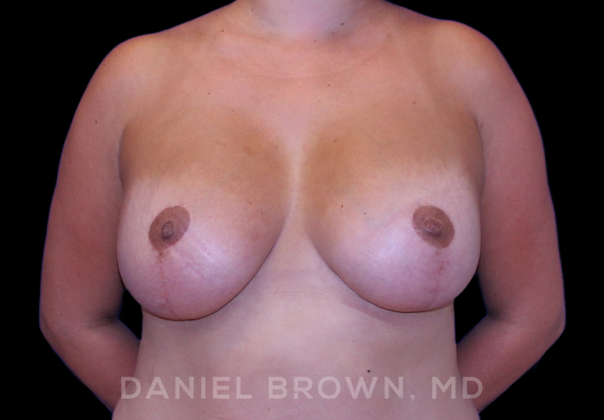 Breast Lift & Implant Patient Photo - Case 1883 - after view