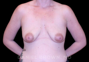 Breast Lift & Implant - Case 1894 - Before