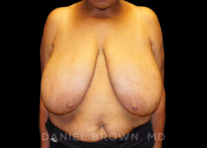 Breast Reduction - Case 1905 - Before