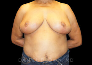 Breast Reduction - Case 1905 - After