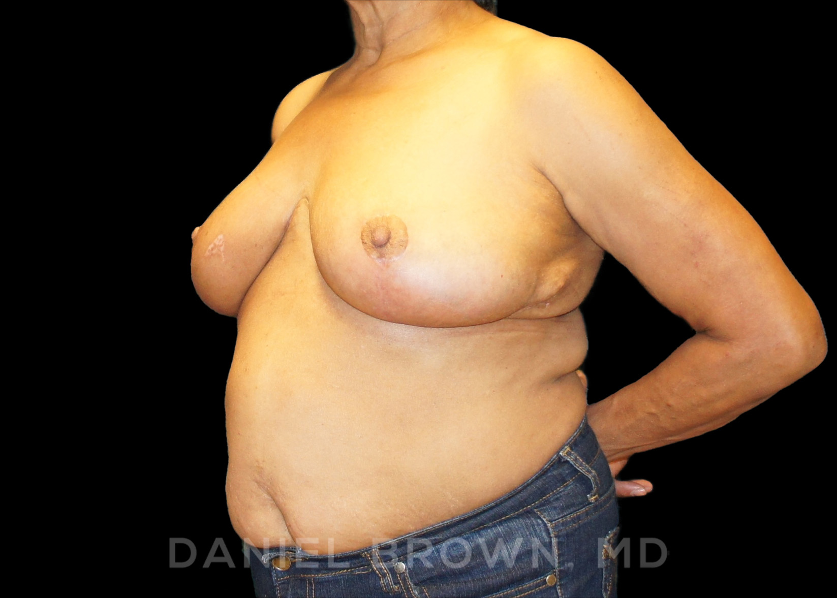 Breast Reduction Patient Photo - Case 1905 - after view-1