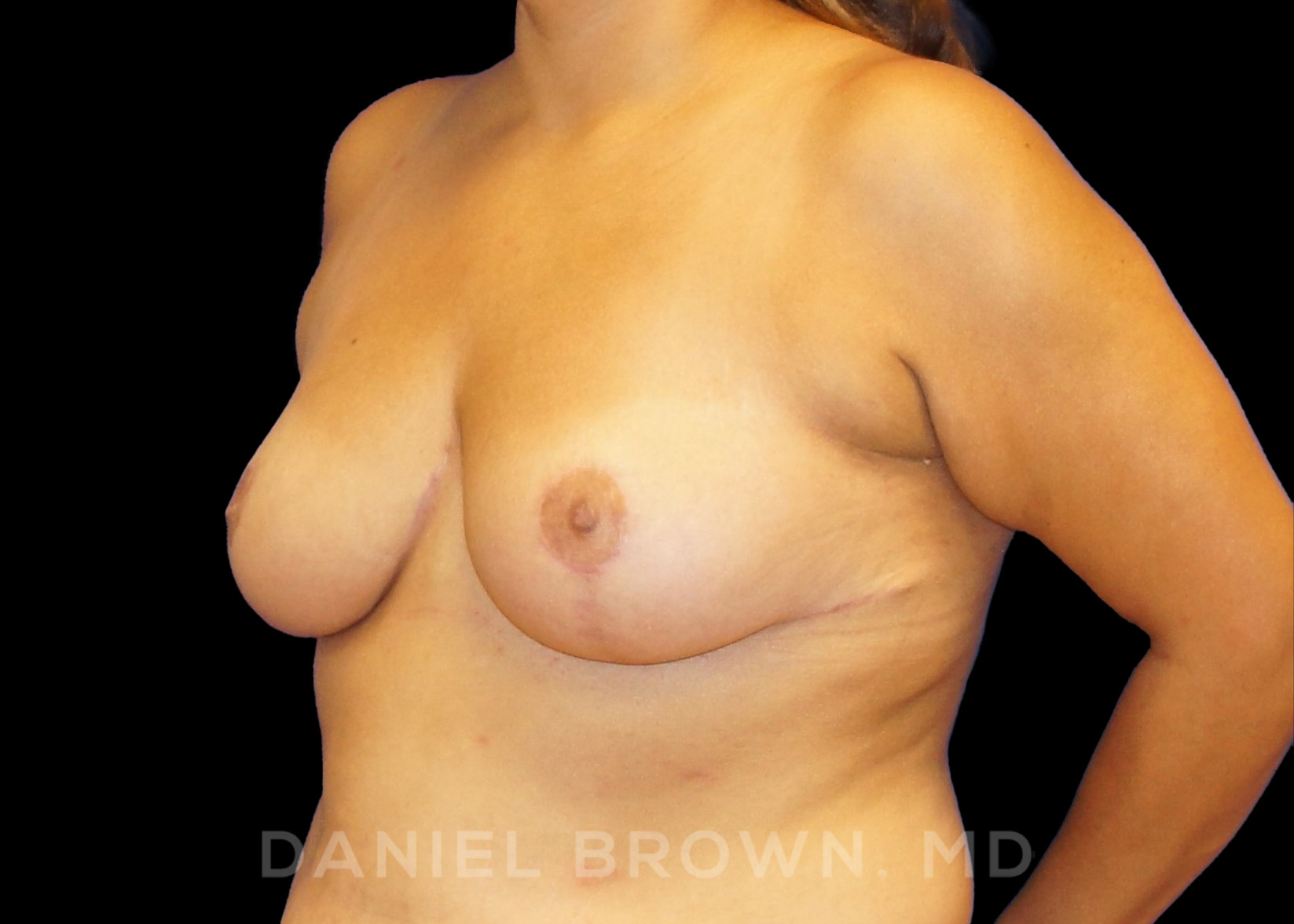 Breast Reduction Patient Photo - Case 1912 - after view