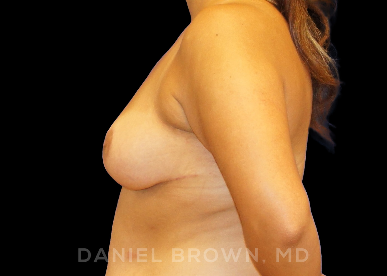 Breast Reduction Patient Photo - Case 1912 - after view-2