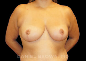 Breast Reduction - Case 1912 - After