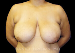 Breast Reduction - Case 1912 - Before