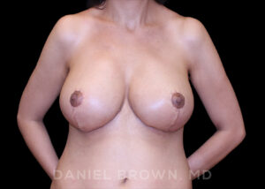 Breast Reduction - Case 1919 - After