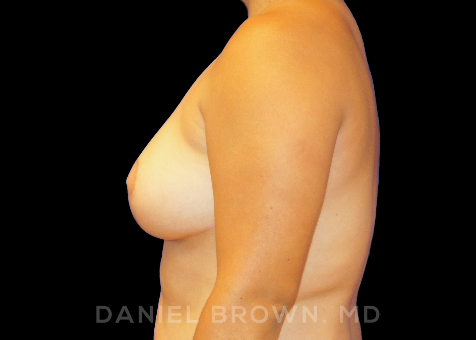 Breast Reduction Patient Photo - Case 1930 - after view-3