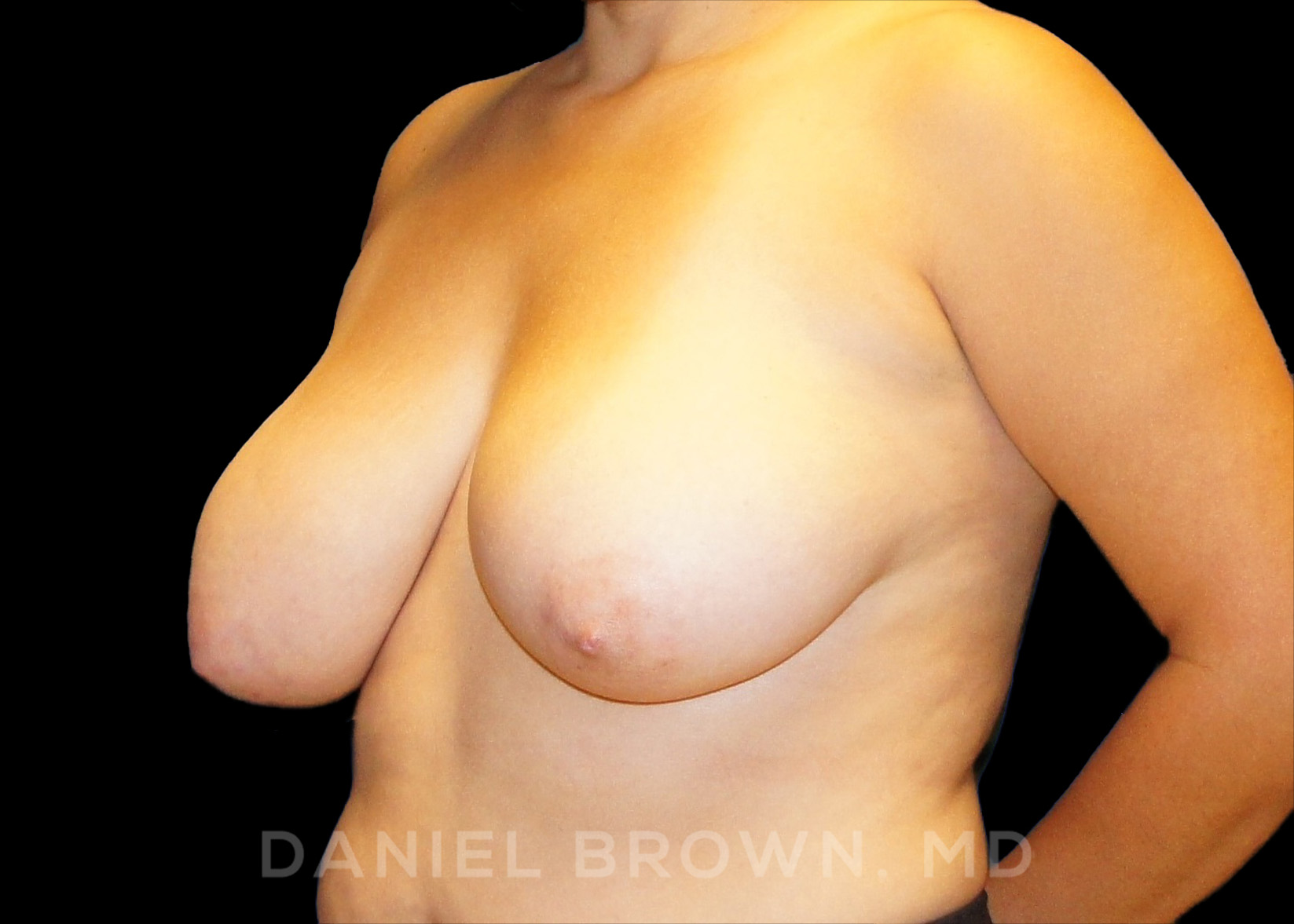 Breast Reduction Patient Photo - Case 1930 - before view-