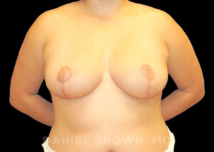 Breast Reduction - Case 1930 - After