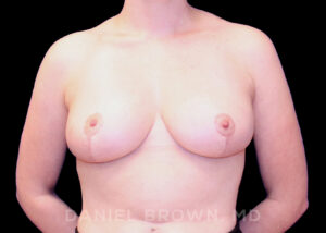 Breast Reduction - Case 1941 - After