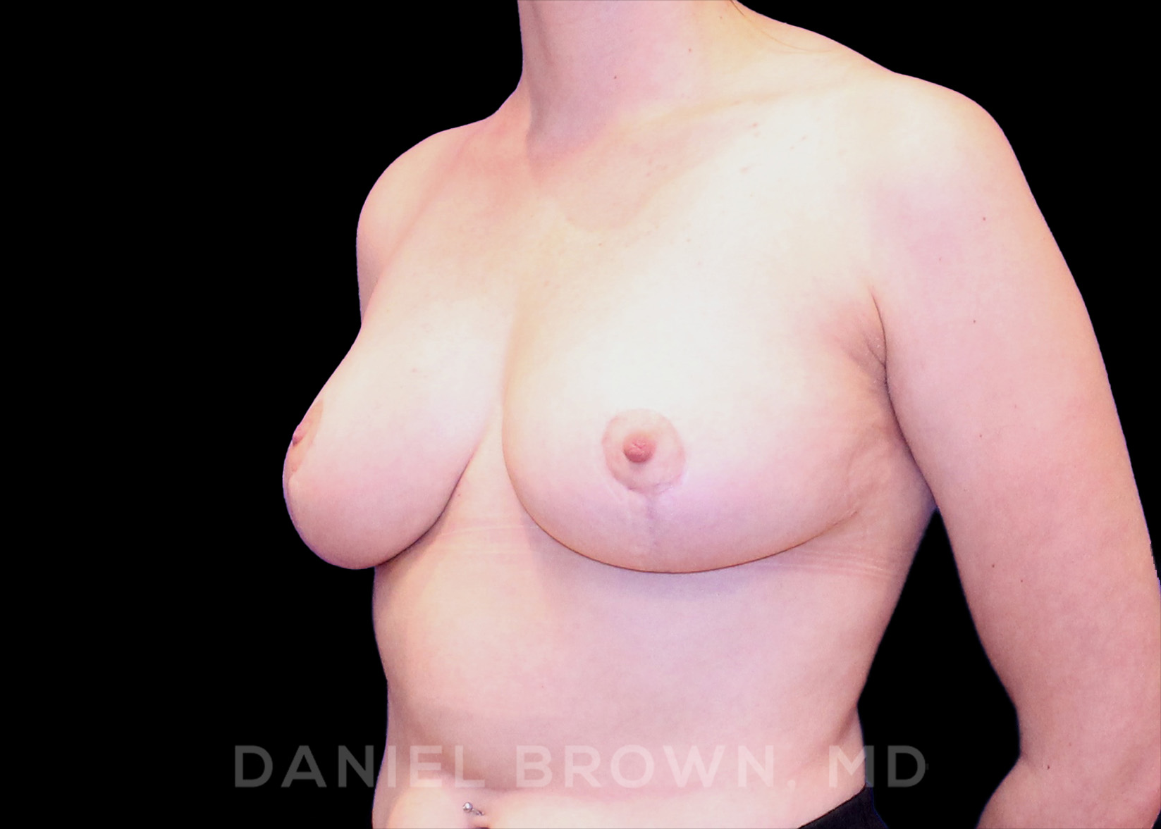 Breast Reduction Patient Photo - Case 1941 - after view-1