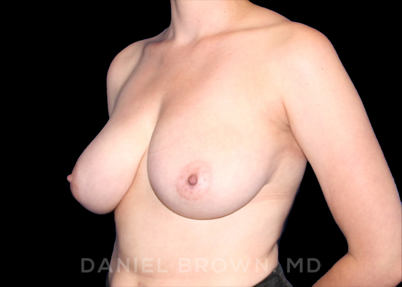 Breast Reduction Patient Photo - Case 1941 - before view-1