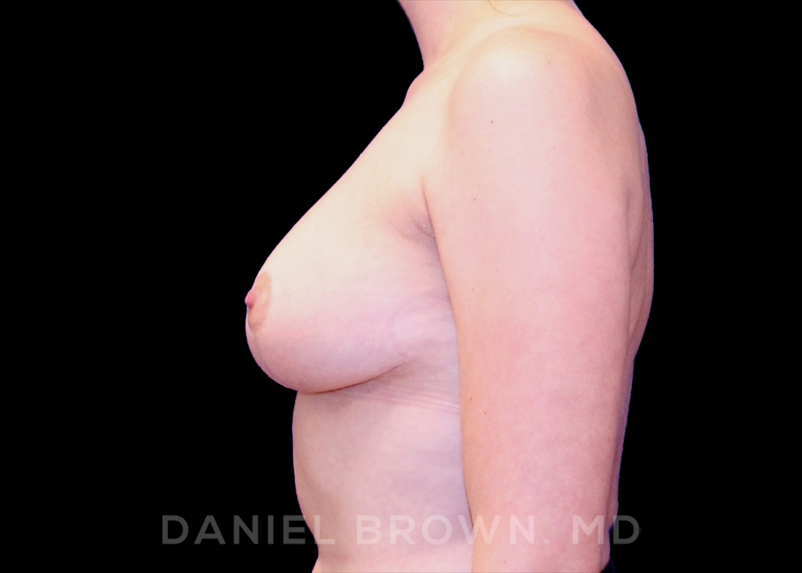 Breast Reduction Patient Photo - Case 1941 - after view