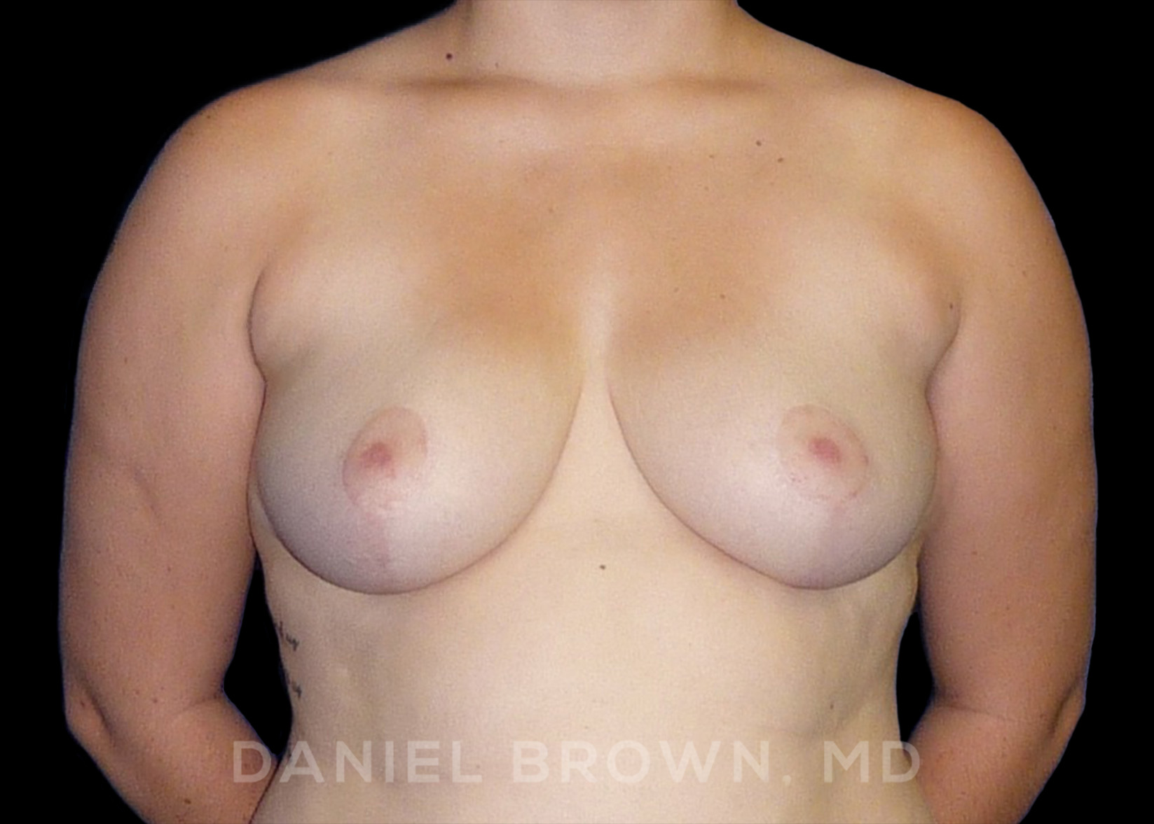 Breast Reduction Patient Photo - Case 1948 - after view-0