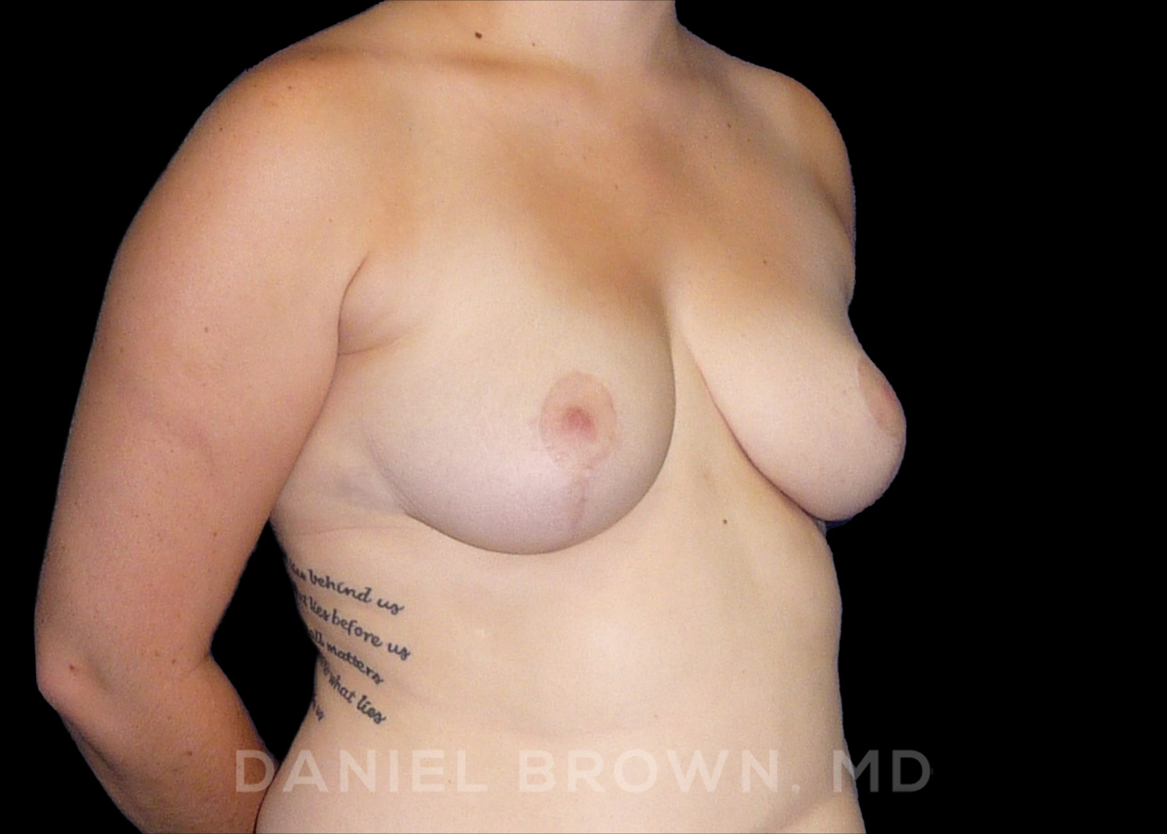 Breast Reduction Patient Photo - Case 1948 - after view-2