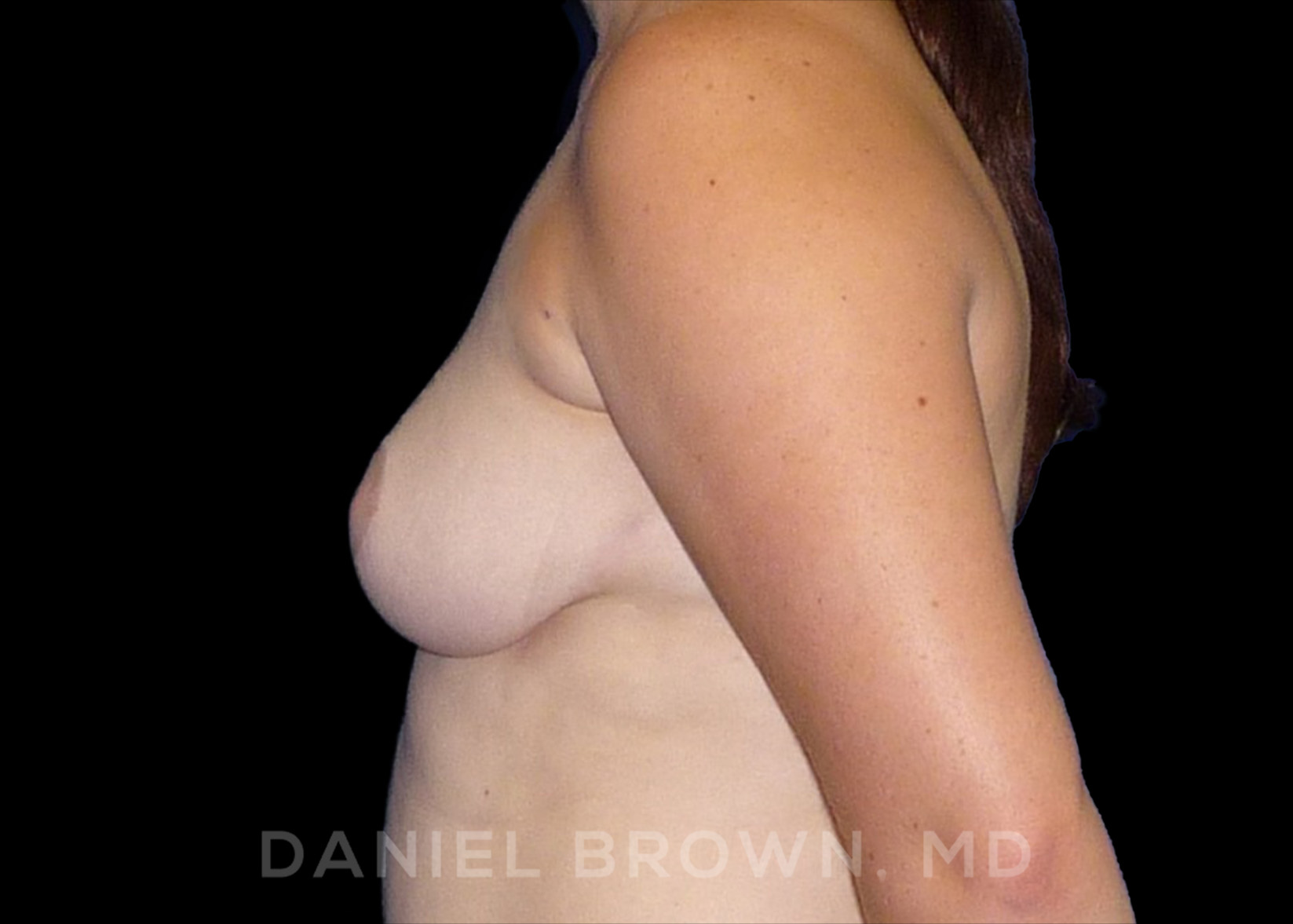 Breast Reduction Patient Photo - Case 1948 - after view-3