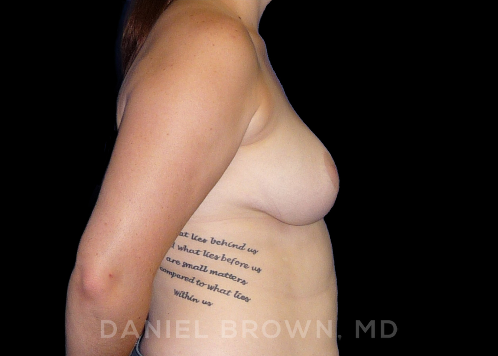 Breast Reduction Patient Photo - Case 1948 - after view