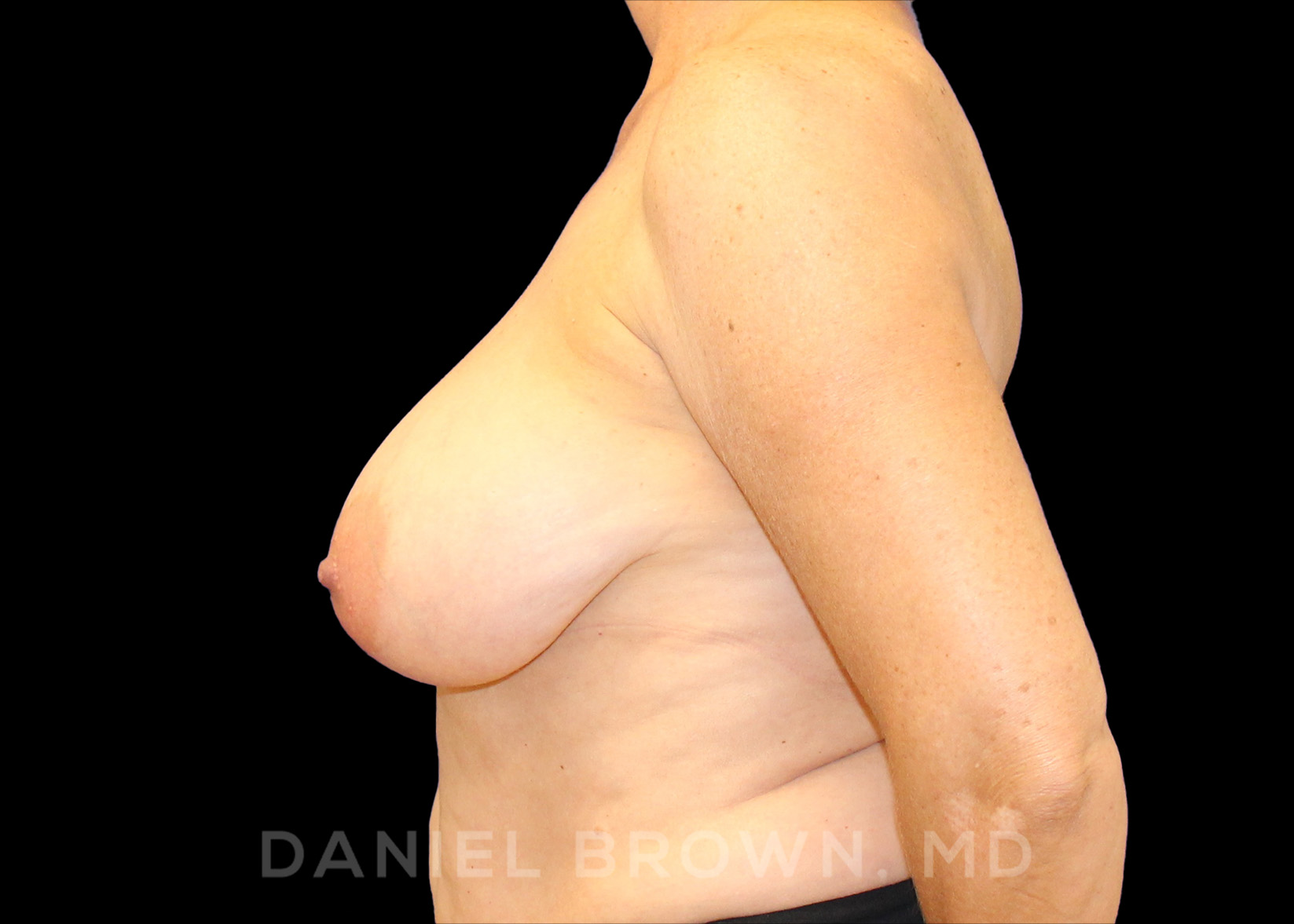 Breast Reduction Patient Photo - Case 1959 - before view-