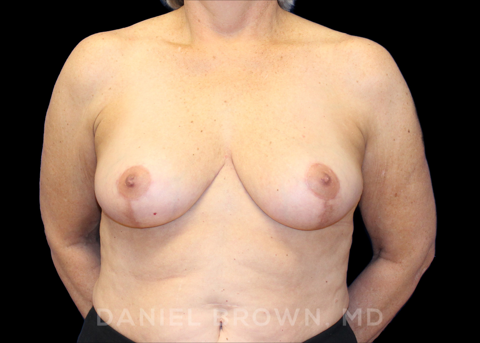 Breast Reduction Patient Photo - Case 1959 - after view