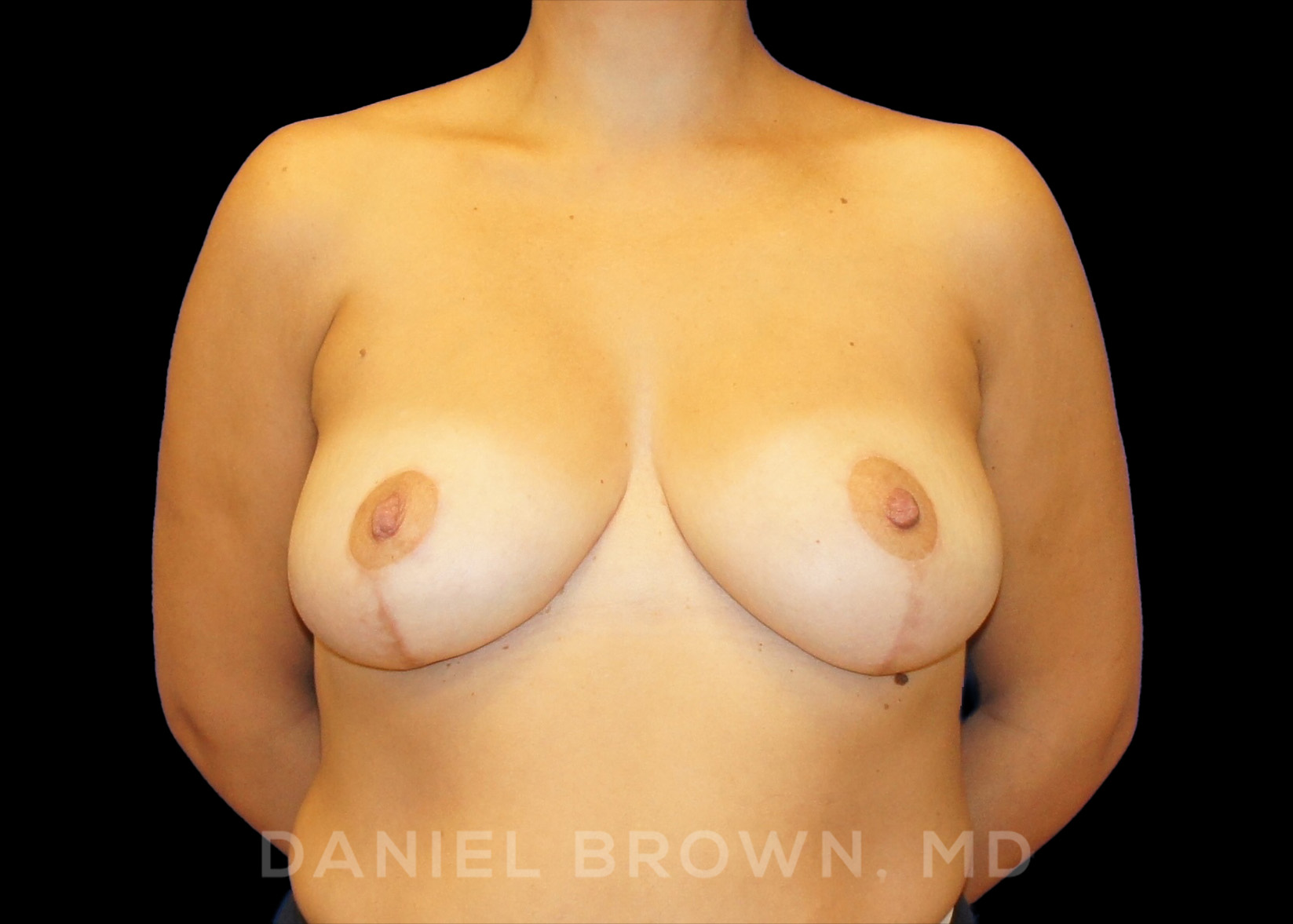 Breast Reduction Patient Photo - Case 1966 - after view-1